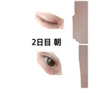 二重埋没 / 目頭切開 かめい美容クリニック宇都宮 DAY 2 サムネイル用
