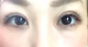 二重切開 / 目頭切開 ばん皮膚科 DAY 146 サムネイル用