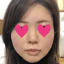 脂肪注入（輪郭） テラクリニック DAY 33 サムネイル用