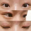 二重埋没 湘南美容クリニック 大阪堺東院 DAY 17 サムネイル用