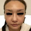 骨削り（エラ） / 骨削り（頬） / その他（輪郭） バノバギ整形外科 DAY 31 サムネイル用