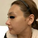 骨削り（エラ） / 骨削り（頬） / その他（輪郭） バノバギ整形外科 DAY 31 サムネイル用