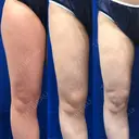 脂肪吸引（脚） / 豊胸（脂肪注入） 水の森美容クリニック 東京新宿院 DAY 90 サムネイル用