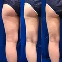 脂肪吸引（脚） / 豊胸（脂肪注入） 水の森美容クリニック 東京新宿院 DAY 90 サムネイル用