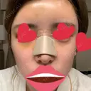 鼻尖形成（切開） / 鼻中隔延長（切開） / バッカルファット除去 / 軟骨移植 / 脂肪注入（額） / 鼻翼基部形成（貴族手術） Zetith Beauty Clinic 銀座院 DAY 5 サムネイル用