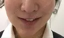 メーラーファット除去 WOM CLINIC GINZA （ワム クリニック ギンザ） DAY 12 サムネイル用