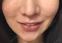 メーラーファット除去 WOM CLINIC GINZA （ワム クリニック ギンザ） DAY 20 サムネイル用