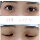 二重埋没 湘南美容クリニック 赤坂見附院 DAY 3 サムネイル用