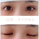 二重埋没 湘南美容クリニック 赤坂見附院 DAY 2 サムネイル用