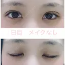 二重埋没 湘南美容クリニック 赤坂見附院 DAY 1 サムネイル用