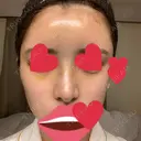 鼻尖形成（切開） / 鼻中隔延長（切開） / バッカルファット除去 / 軟骨移植 / 脂肪注入（額） / 鼻翼基部形成（貴族手術） Zetith Beauty Clinic 銀座院 DAY 6 サムネイル用