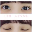 二重埋没 湘南美容クリニック 赤坂見附院 DAY 4 サムネイル用