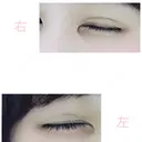 二重埋没 湘南美容クリニック 赤坂見附院 DAY 4 サムネイル用