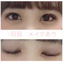 二重埋没 湘南美容クリニック 赤坂見附院 DAY 4 サムネイル用