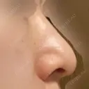 鼻尖形成（切開） / 小鼻縮小（切開） / 軟骨移植 湘南メディカル記念病院（両国） DAY 1096 サムネイル用