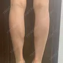 ボトックス（ふくらはぎ） TCB東京中央美容外科 中野院 DAY 0 サムネイル用