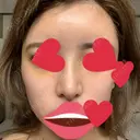 鼻尖形成（切開） / 鼻中隔延長（切開） / バッカルファット除去 / 軟骨移植 / 脂肪注入（額） / 鼻翼基部形成（貴族手術） Zetith Beauty Clinic 銀座院 DAY 7 サムネイル用