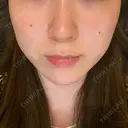ハイフ（顔） Zetith Beauty Clinic 銀座院 DAY 0 サムネイル用