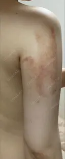 GLP-1ダイエット / 脂肪溶解注射（二の腕） / その他（ボディ） 湘南美容クリニック 新橋銀座口院 DAY 2 サムネイル用