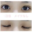 二重埋没 湘南美容クリニック 赤坂見附院 DAY 5 サムネイル用