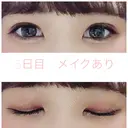 二重埋没 湘南美容クリニック 赤坂見附院 DAY 5 サムネイル用