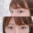 脂肪溶解注射（まぶた） 銀座フェイスクリニック（小顔整形・輪郭整形專門） DAY 14 サムネイル用