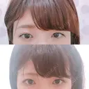 脂肪溶解注射（まぶた） 銀座フェイスクリニック（小顔整形・輪郭整形專門） AFTER サムネイル用