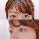 脂肪溶解注射（まぶた） 銀座フェイスクリニック（小顔整形・輪郭整形專門） DAY 27 サムネイル用