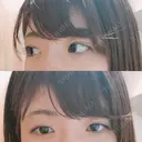 脂肪溶解注射（まぶた） 銀座フェイスクリニック（小顔整形・輪郭整形專門） DAY 27 サムネイル用