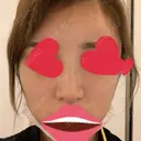 鼻尖形成（切開） / 鼻中隔延長（切開） / バッカルファット除去 / 軟骨移植 / 脂肪注入（額） / 鼻翼基部形成（貴族手術） Zetith Beauty Clinic 銀座院 DAY 8 サムネイル用