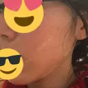 糸リフト 品川スキンクリニック京都院 DAY 0 サムネイル用