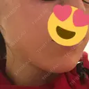 糸リフト 品川スキンクリニック京都院 DAY 0 サムネイル用