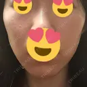 糸リフト 品川スキンクリニック京都院 DAY 6 サムネイル用