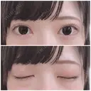 二重切開 / 上まぶたたるみ取り / 上まぶたの脂肪取り 銀座高須クリニック DAY 124 サムネイル用