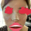 鼻尖形成（切開） / 鼻中隔延長（切開） / バッカルファット除去 / 軟骨移植 / 脂肪注入（額） / 鼻翼基部形成（貴族手術） Zetith Beauty Clinic 銀座院 DAY 9 サムネイル用