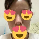 鼻尖形成（切開） / ヒアルロン酸注入（鼻） 東京ヒルズクリニック 新宿院 DAY 27 サムネイル用