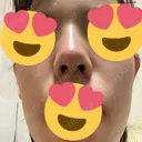 鼻尖形成（切開） / ヒアルロン酸注入（鼻） 東京ヒルズクリニック 新宿院 DAY 27 サムネイル用