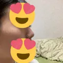 鼻尖形成（切開） / ヒアルロン酸注入（鼻） 東京ヒルズクリニック 新宿院 DAY 27 サムネイル用