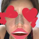 鼻尖形成（切開） / 鼻中隔延長（切開） / バッカルファット除去 / 軟骨移植 / 脂肪注入（額） / 鼻翼基部形成（貴族手術） Zetith Beauty Clinic 銀座院 DAY 10 サムネイル用