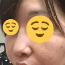 小鼻縮小（切開） / その他（鼻） 湘南メディカル記念病院（両国） DAY 10 サムネイル用