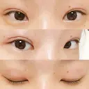 二重埋没 湘南美容クリニック 大阪堺東院 DAY 18 サムネイル用