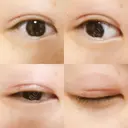 二重埋没 湘南美容クリニック 大阪堺東院 DAY 18 サムネイル用