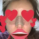 鼻尖形成（切開） / 鼻中隔延長（切開） / バッカルファット除去 / 軟骨移植 / 脂肪注入（額） / 鼻翼基部形成（貴族手術） Zetith Beauty Clinic 銀座院 AFTER サムネイル用