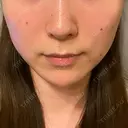 ハイフ（顔） Zetith Beauty Clinic 銀座院 DAY 5 サムネイル用