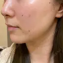 ハイフ（顔） Zetith Beauty Clinic 銀座院 DAY 5 サムネイル用