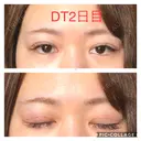 二重埋没 城本クリニック 四日市院 DAY 2 サムネイル用