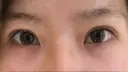 眼瞼下垂（切開） 芦屋美容クリニック 芦屋院 AFTER サムネイル用