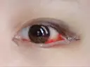 目頭切開 / 目尻切開 FROM B整形外科 (旧バウム整形外科) DAY 4 サムネイル用