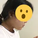 その他（輪郭） 品川美容外科 静岡院 DAY 35 サムネイル用