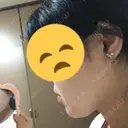 その他（輪郭） 品川美容外科 静岡院 DAY 35 サムネイル用